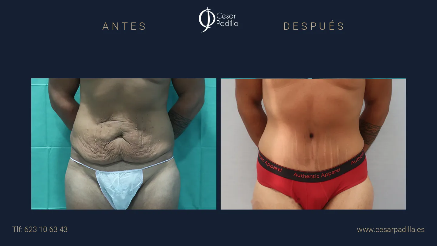 Antes y después de Abdominoplastia masculina