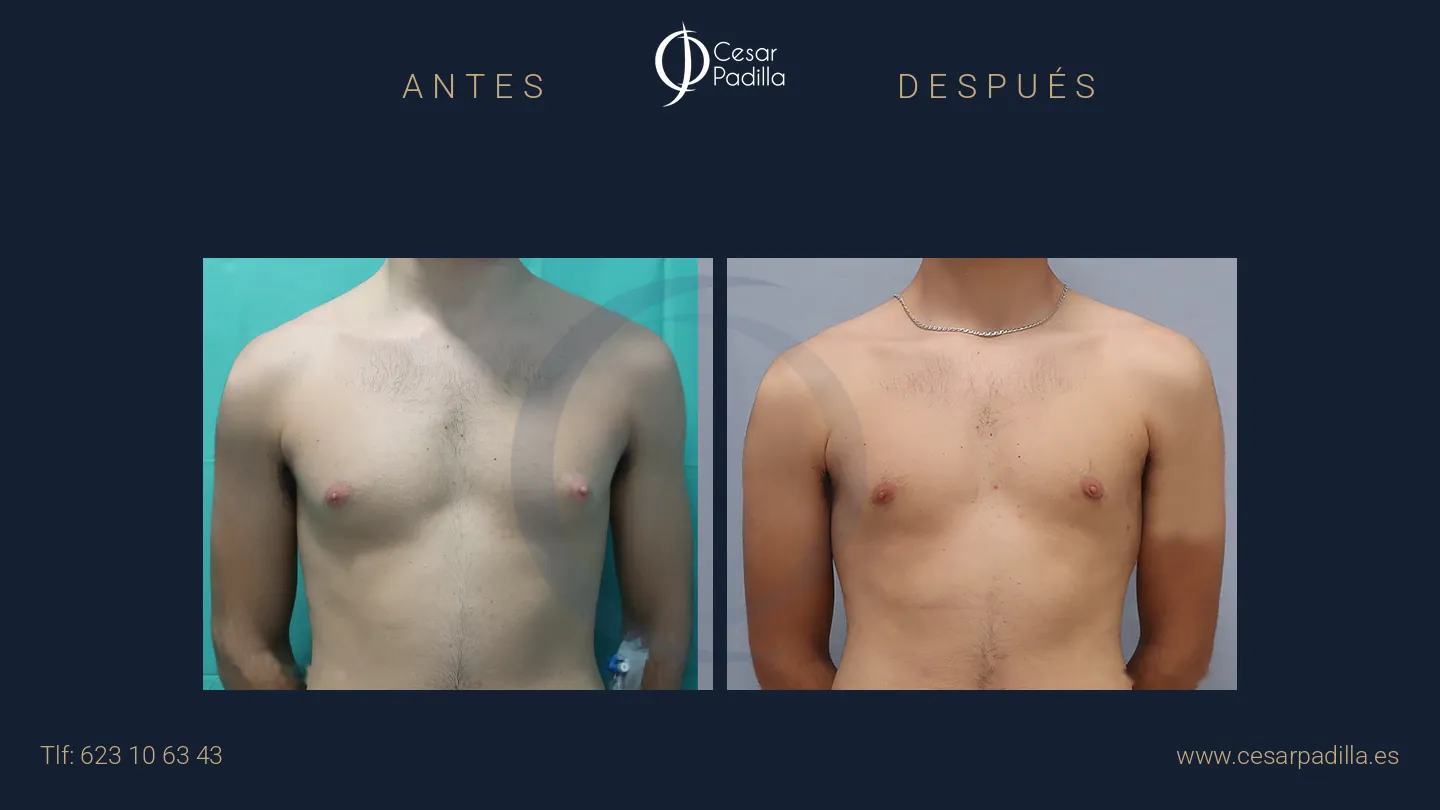 Antes y después de Ginecomastia