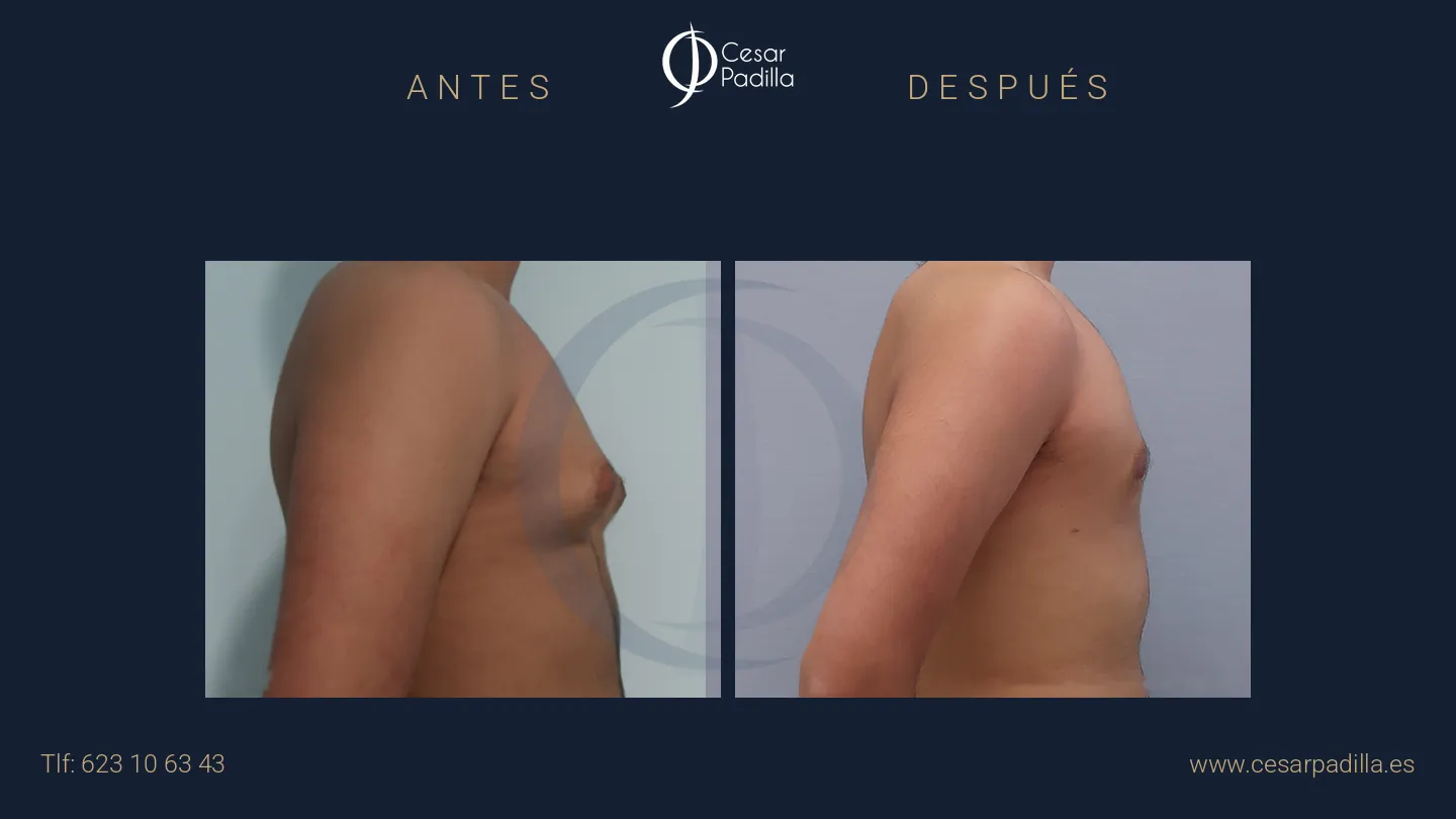 Antes y después de Ginecomastia