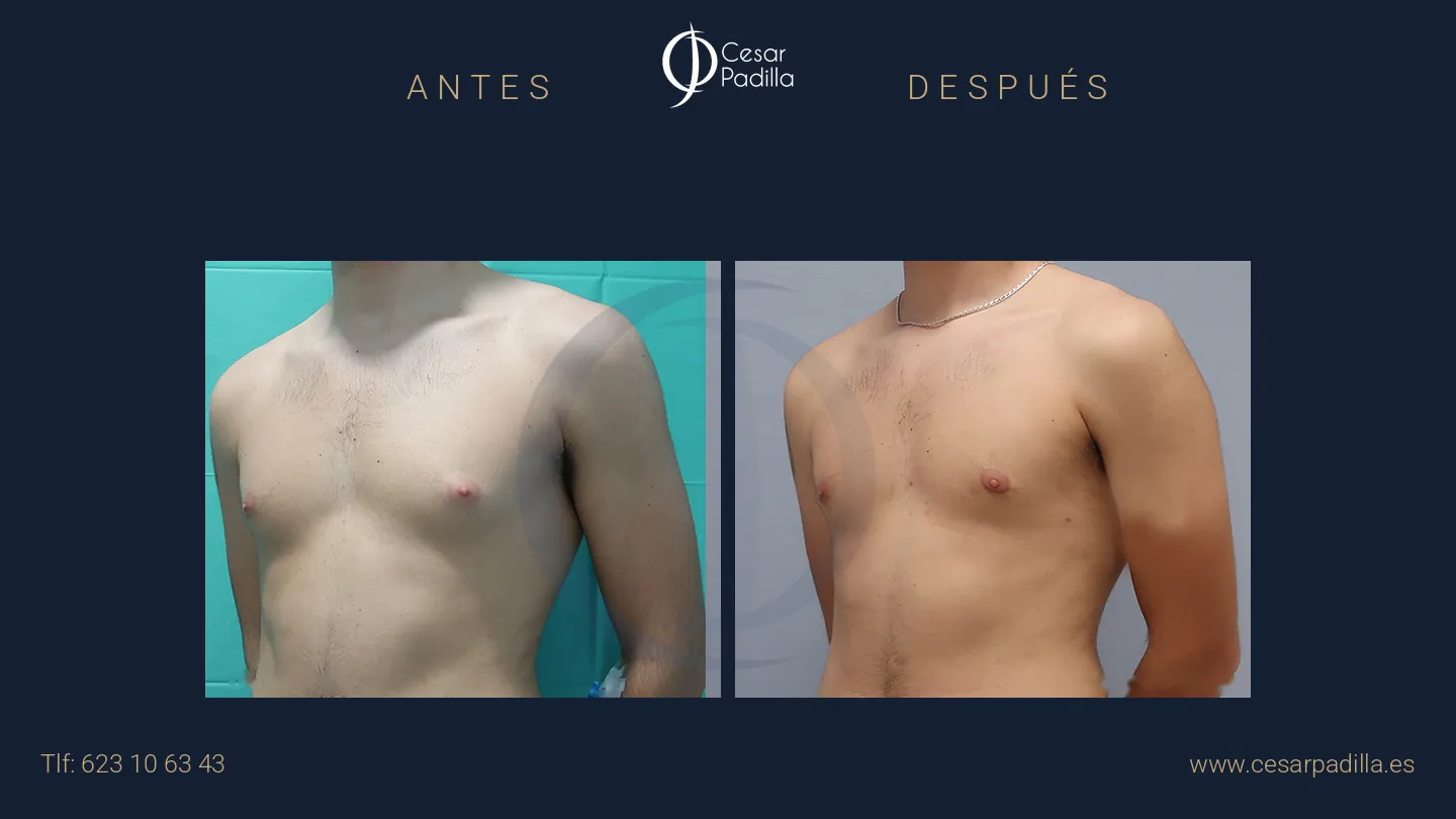 Antes y después de Ginecomastia