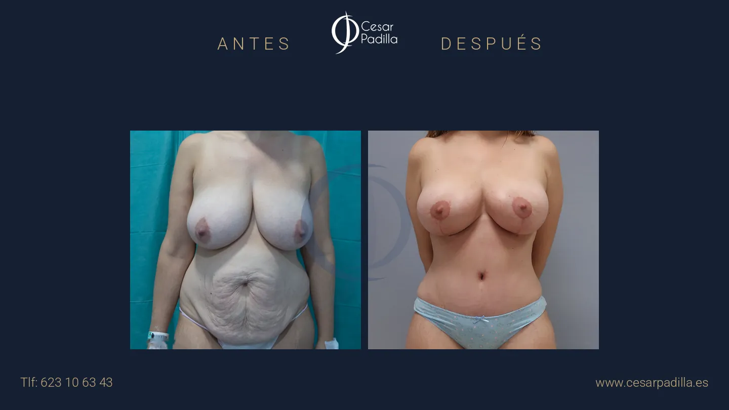 Mommy Makeover en Málaga | Dr. César Padilla