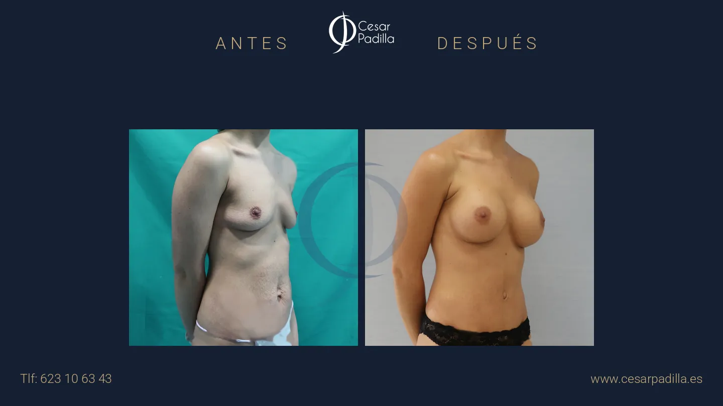 Antes y después de Mommy Makeover, caso 11