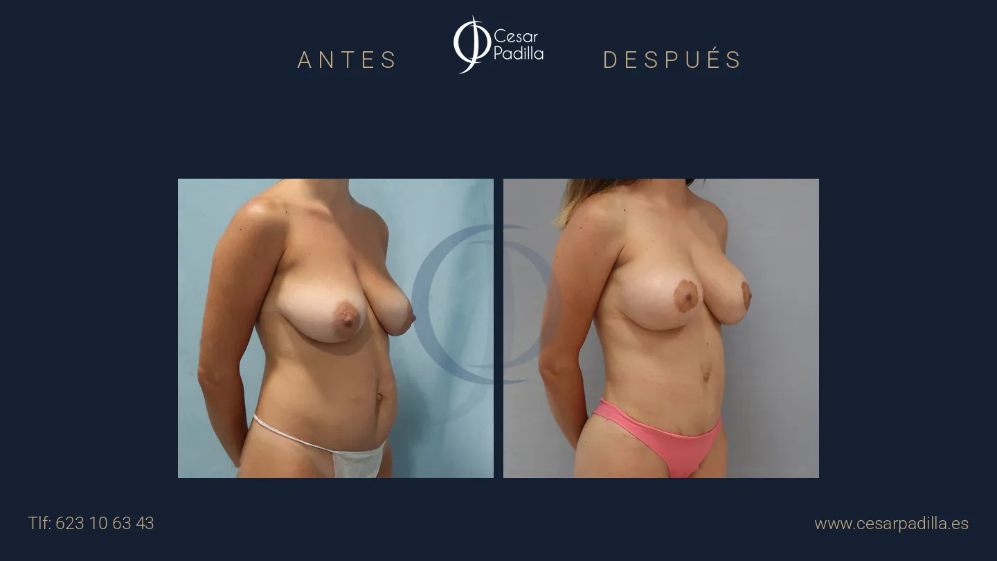Antes y después de Mommy Makeover, caso 12