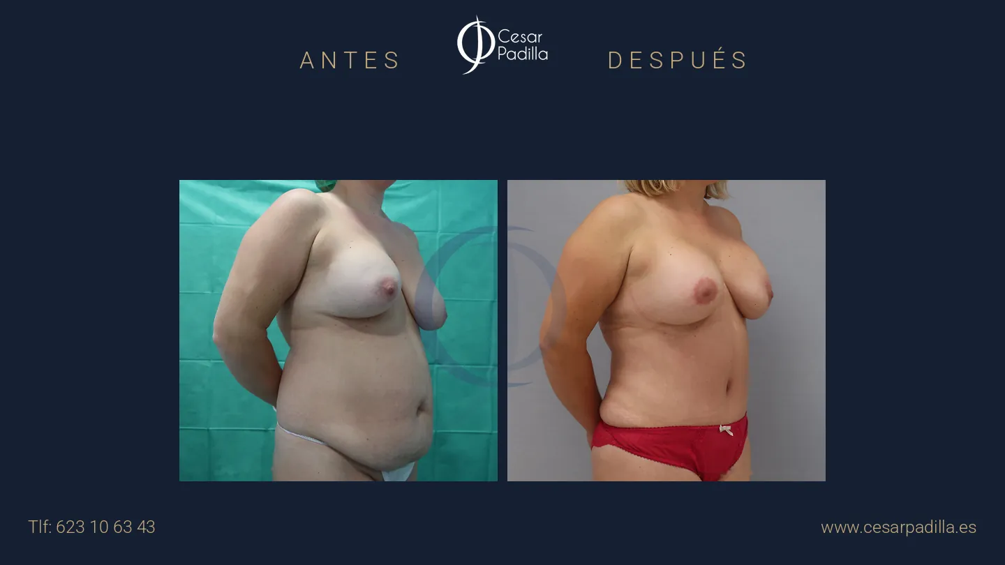 Antes y después de Mommy Makeover, caso 14