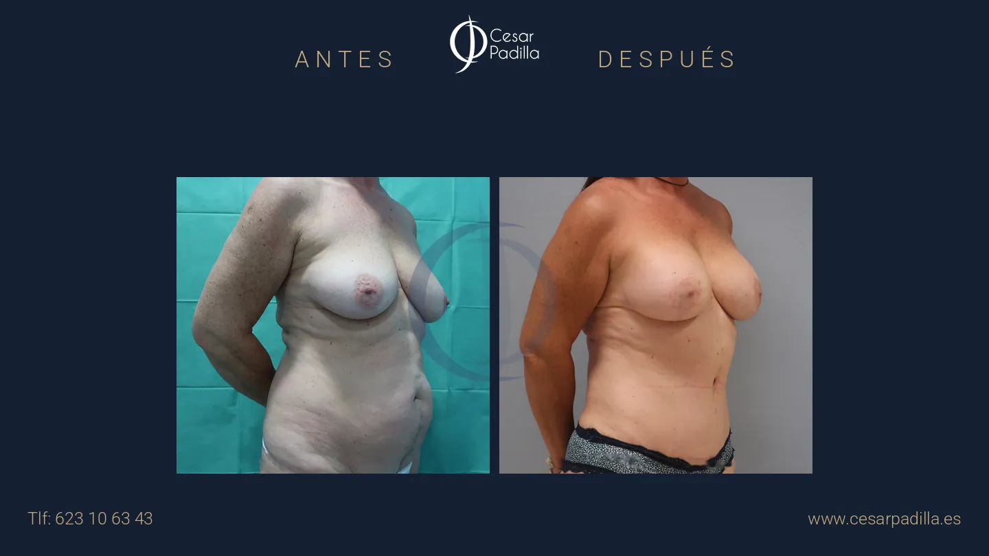 Antes y después de Mommy Makeover, caso 15