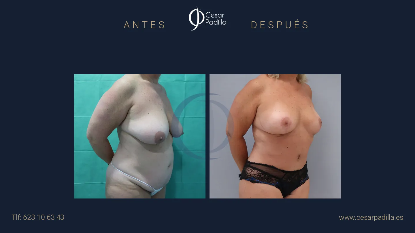 Antes y después de Mommy Makeover, caso 16