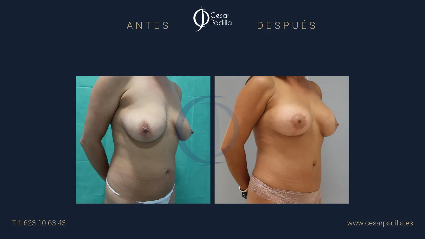 Antes y después de Mommy Makeover, caso 17