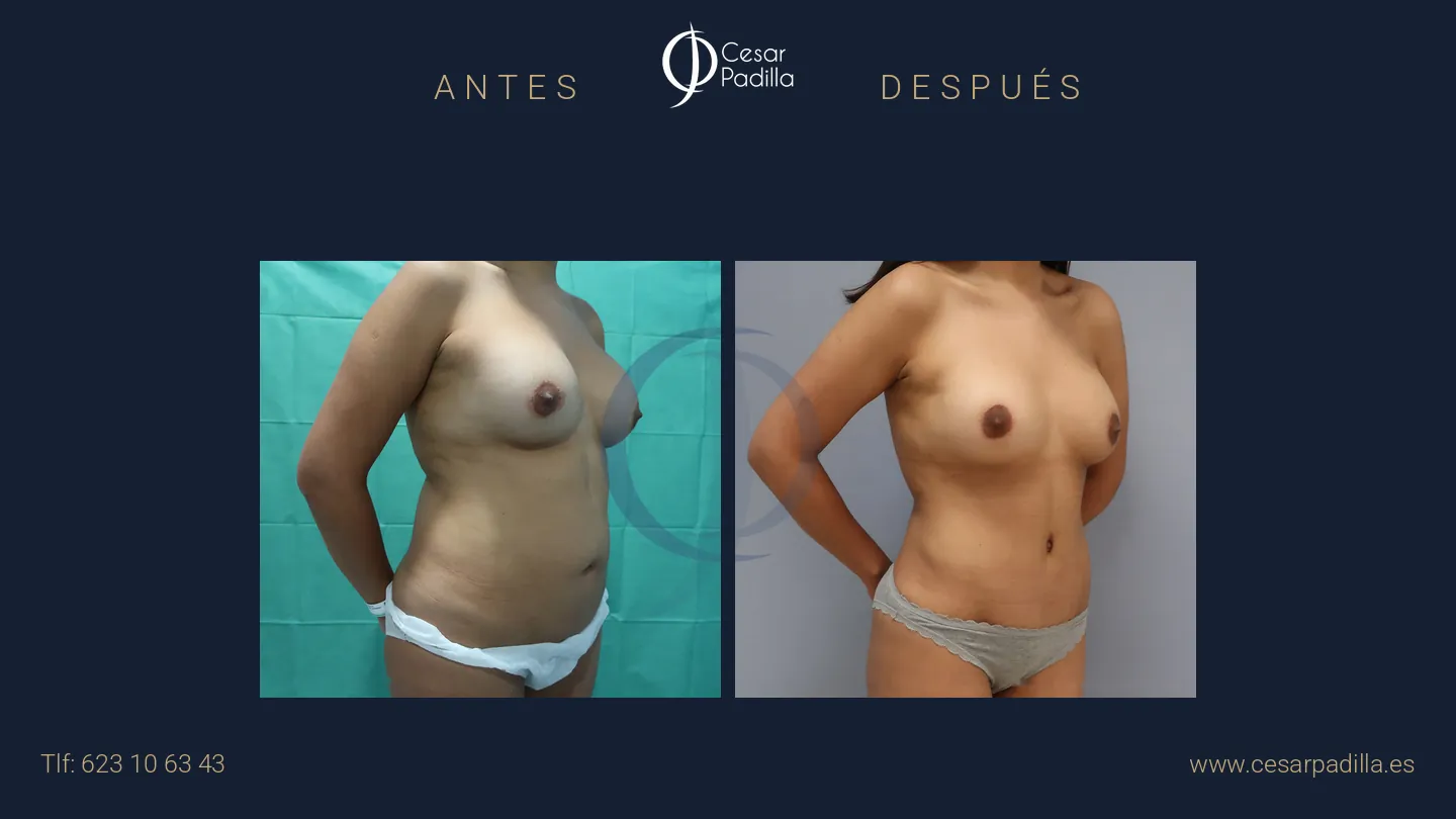 Antes y después de Mommy Makeover, caso 18