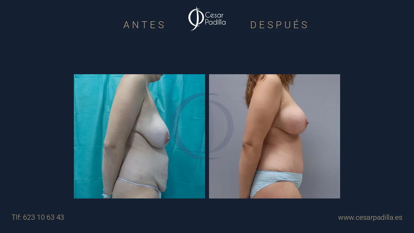 Antes y después de Mommy Makeover, caso 19
