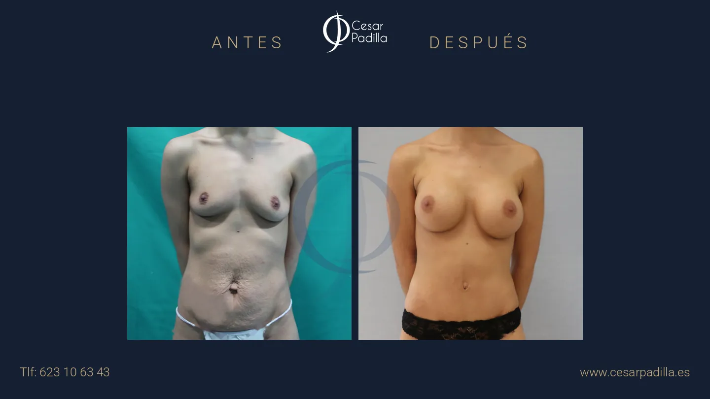 Antes y después de Mommy Makeover