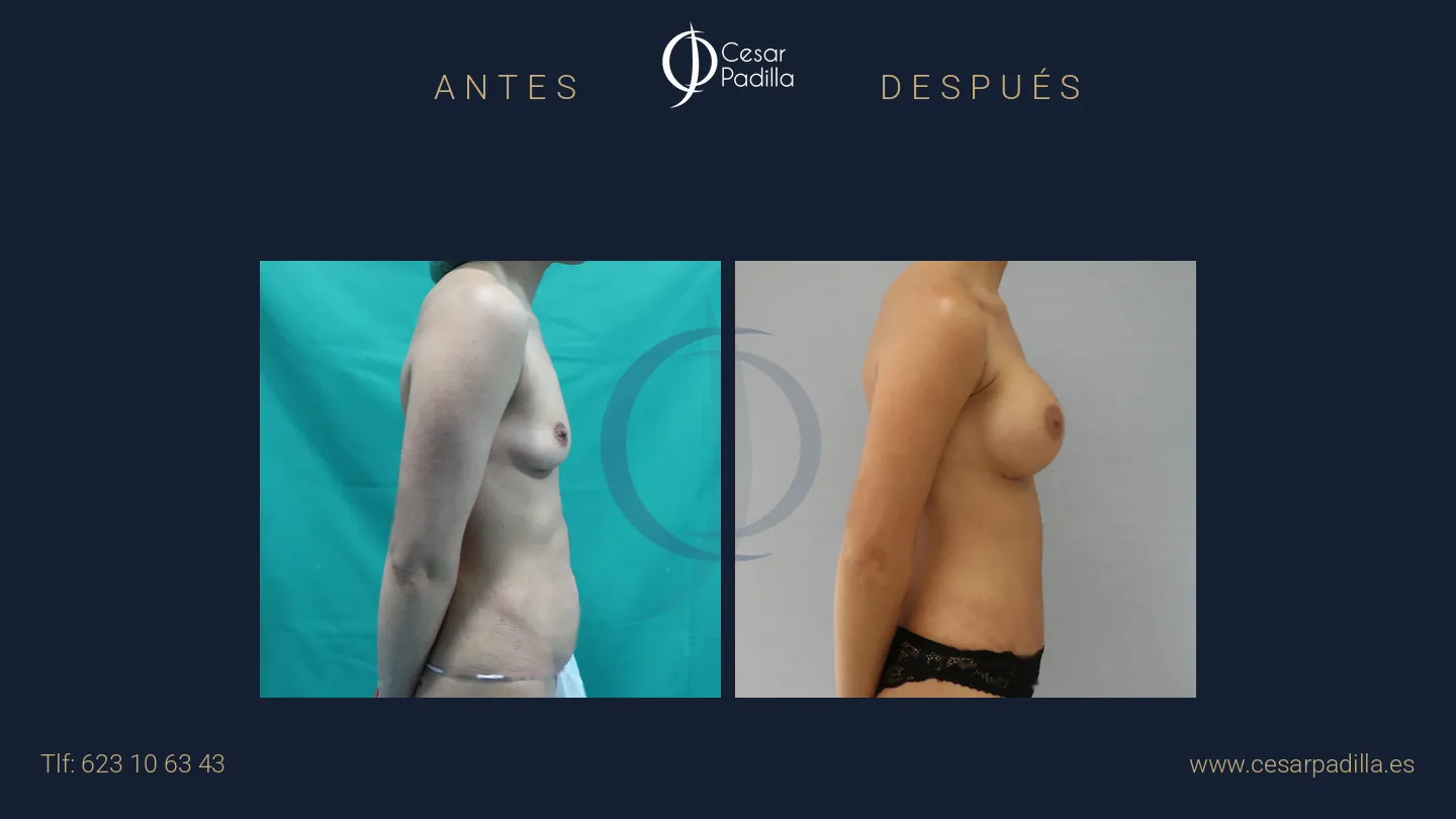 Antes y después de Mommy Makeover, caso 20