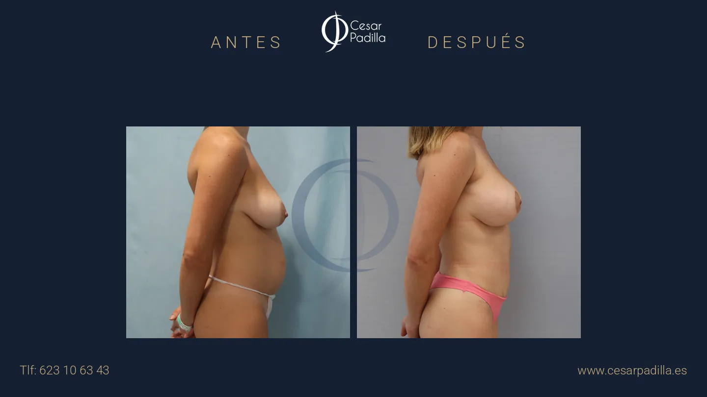 Antes y después de Mommy Makeover, caso 21