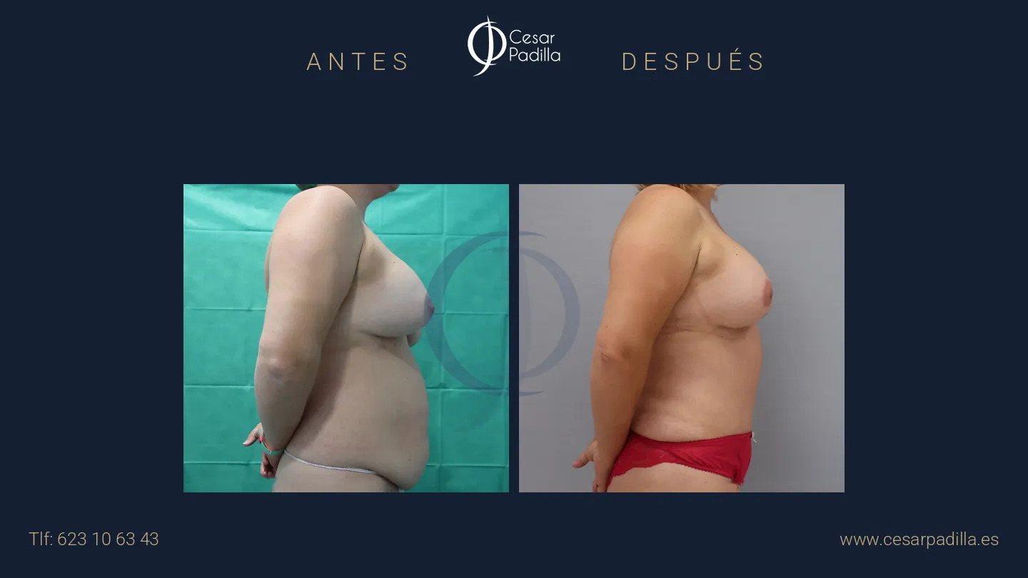 Antes y después de Mommy Makeover, caso 23