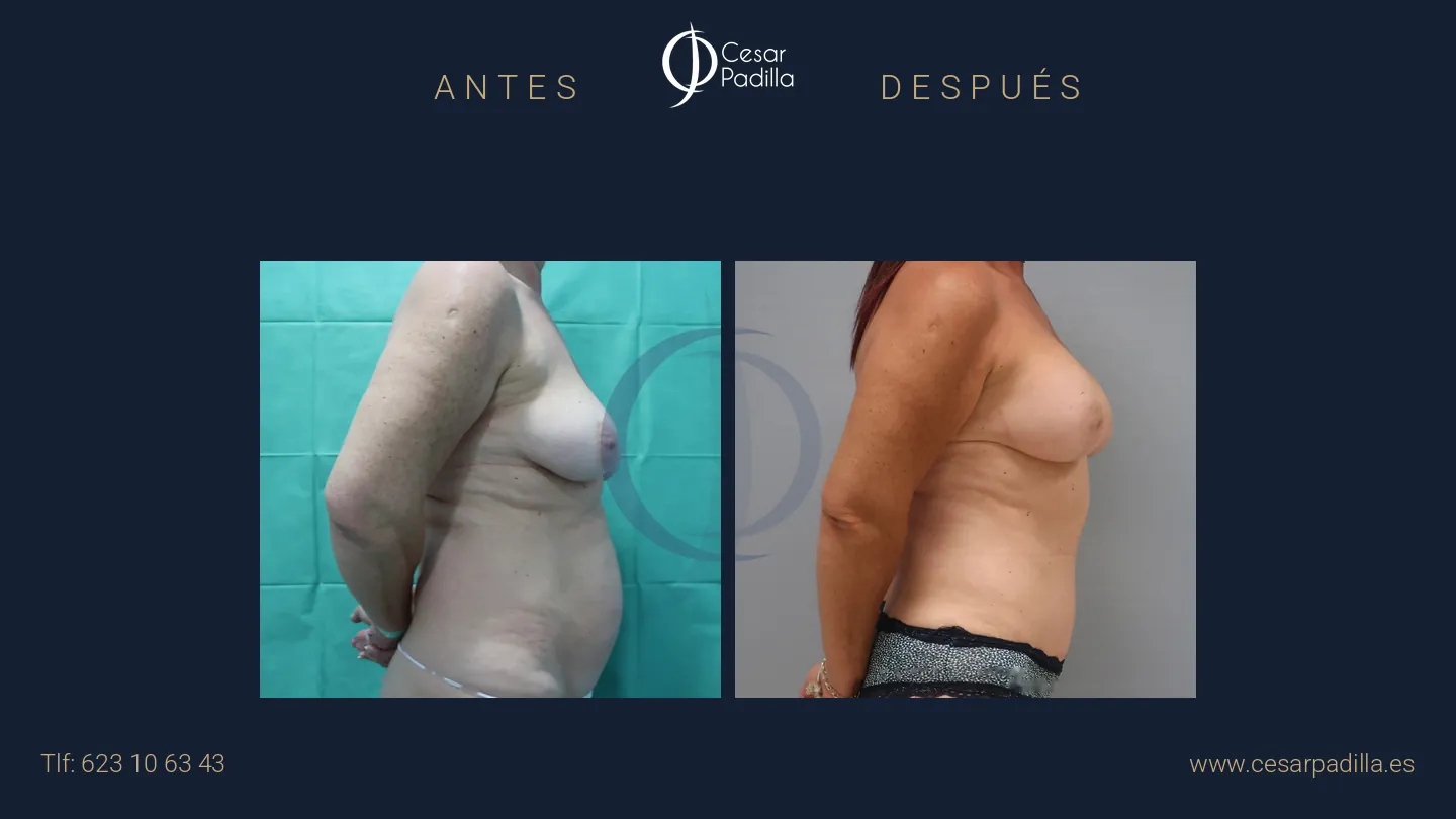 Antes y después de Mommy Makeover, caso 24