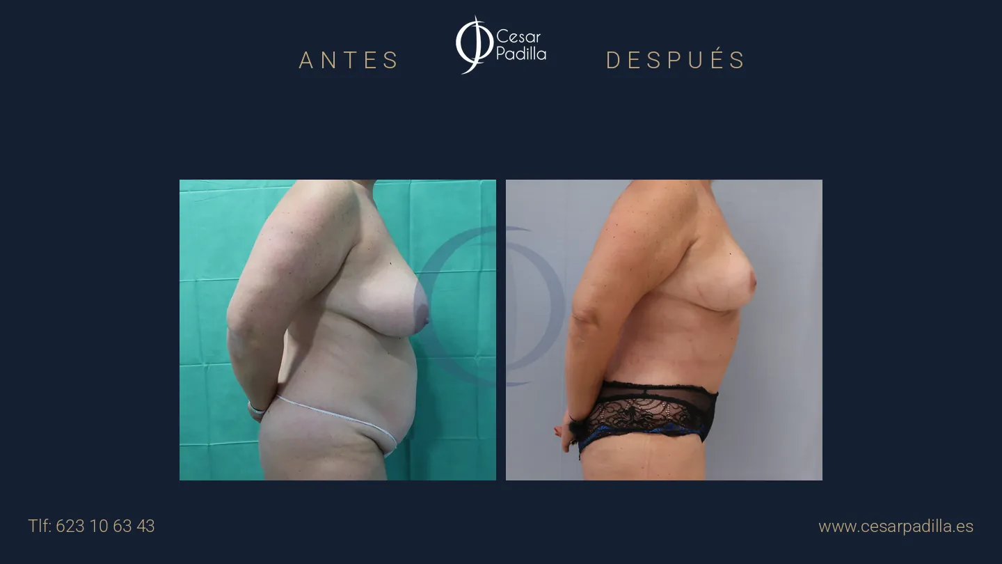 Antes y después de Mommy Makeover, caso 25