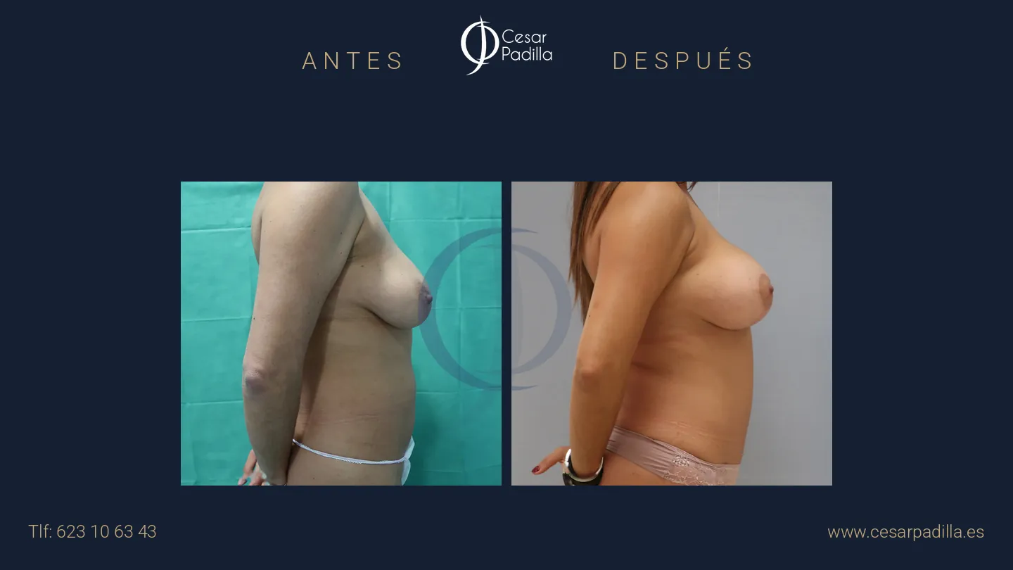 Antes y después de Mommy Makeover, caso 26