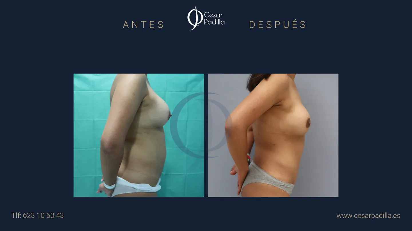 Antes y después de Mommy Makeover, caso 27