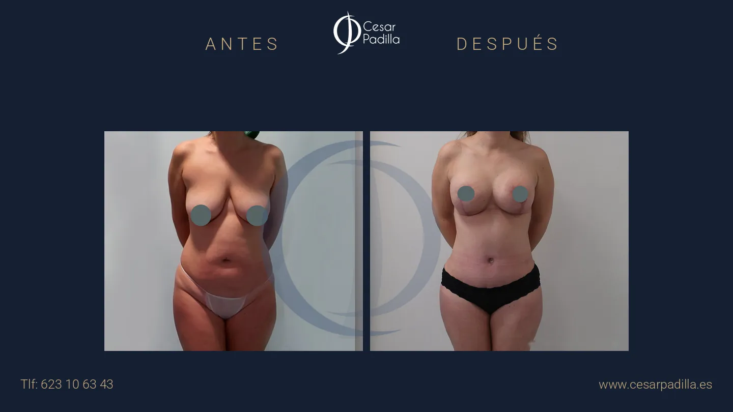 Antes y después de Mommy Makeover, caso 28