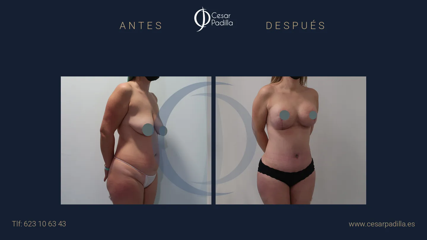 Antes y después de Mommy Makeover, caso 29