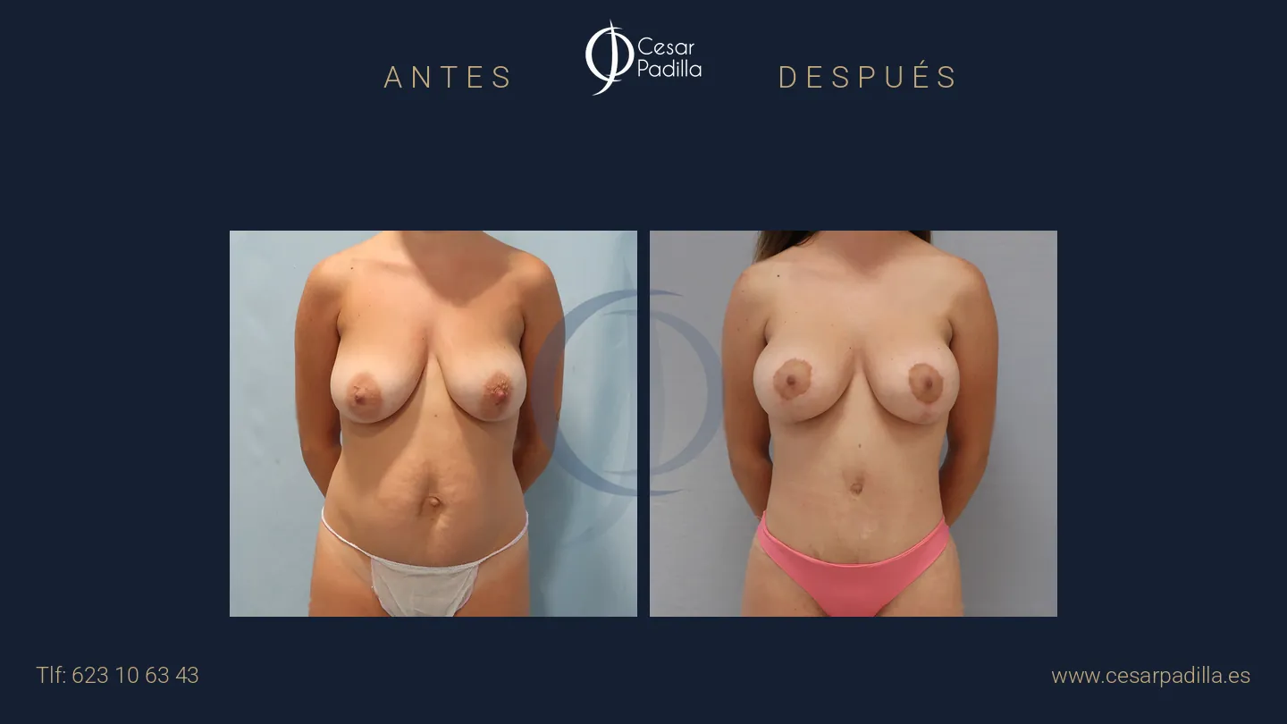Antes y después de Mommy Makeover