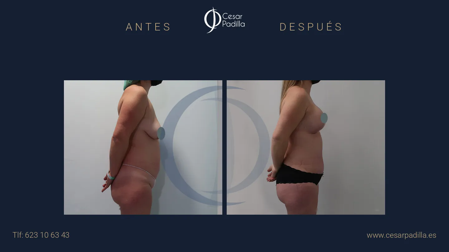 Antes y después de Mommy Makeover, caso 30