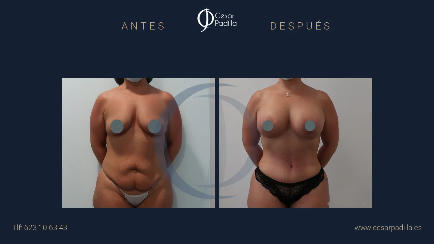 Antes y después de Mommy Makeover, caso 31
