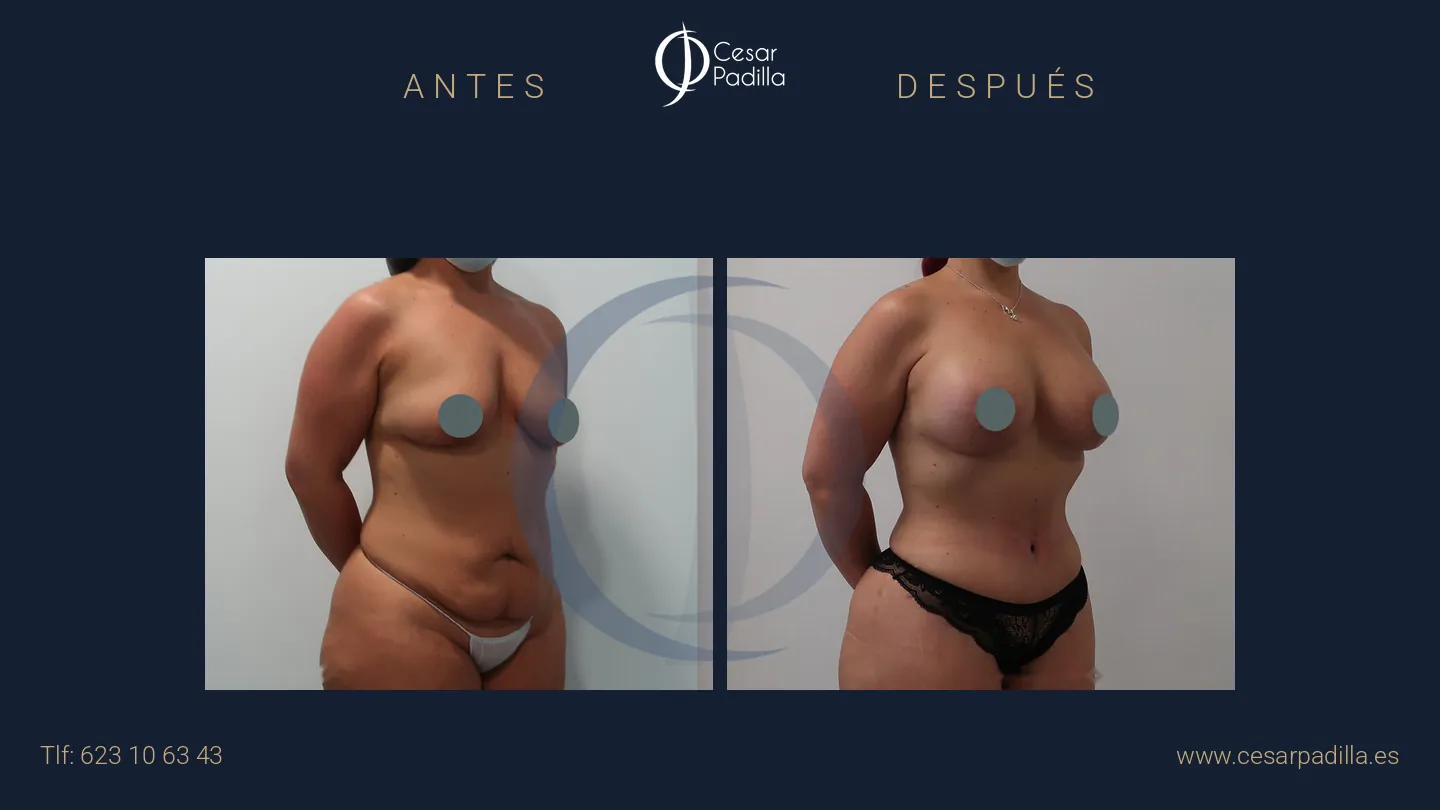 Antes y después de Mommy Makeover, caso 32