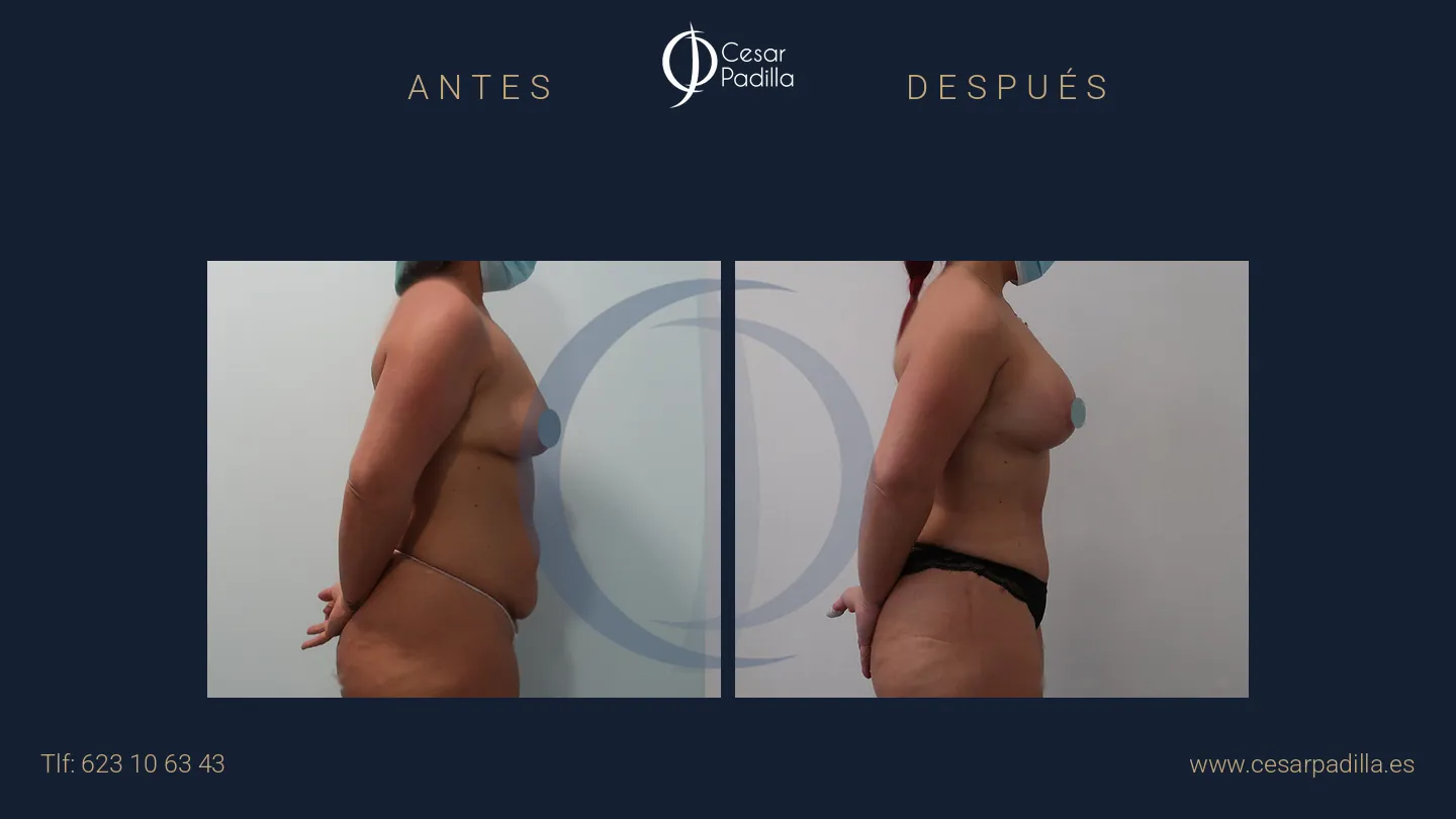 Antes y después de Mommy Makeover, caso 33