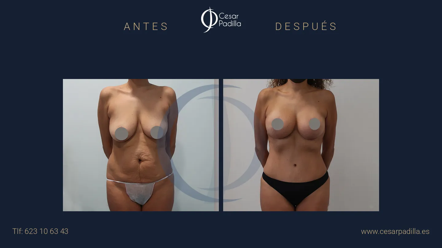 Antes y después de Mommy Makeover, caso 34
