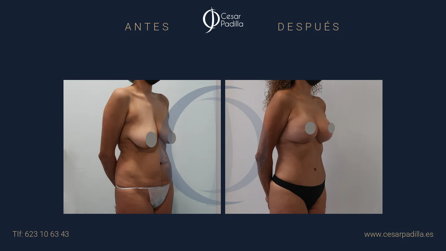 Antes y después de Mommy Makeover, caso 35