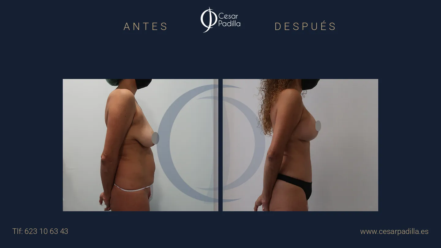 Antes y después de Mommy Makeover, caso 36