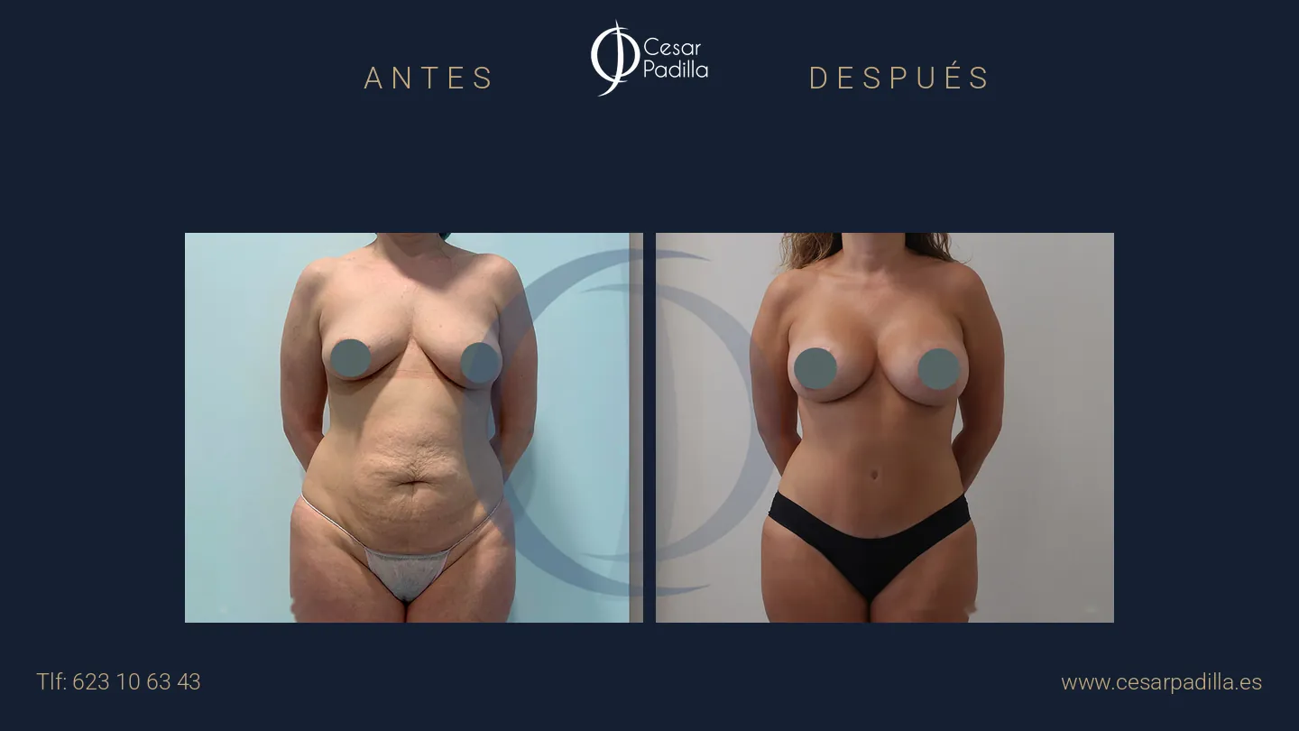 Antes y después de Mommy Makeover, caso 37