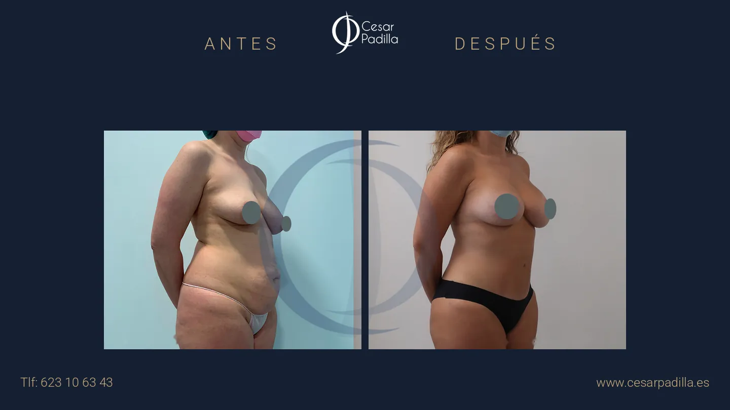 Antes y después de Mommy Makeover, caso 38