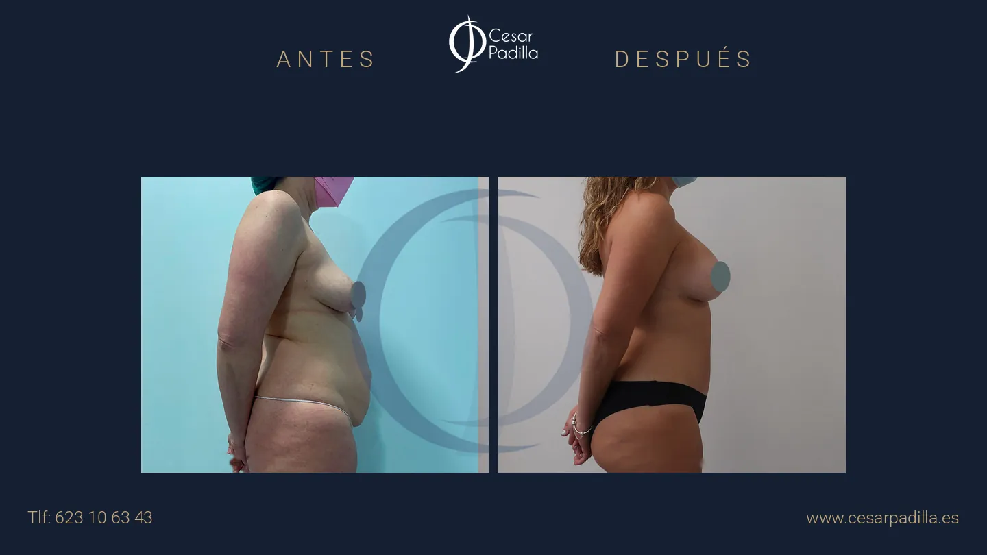 Antes y después de Mommy Makeover, caso 39