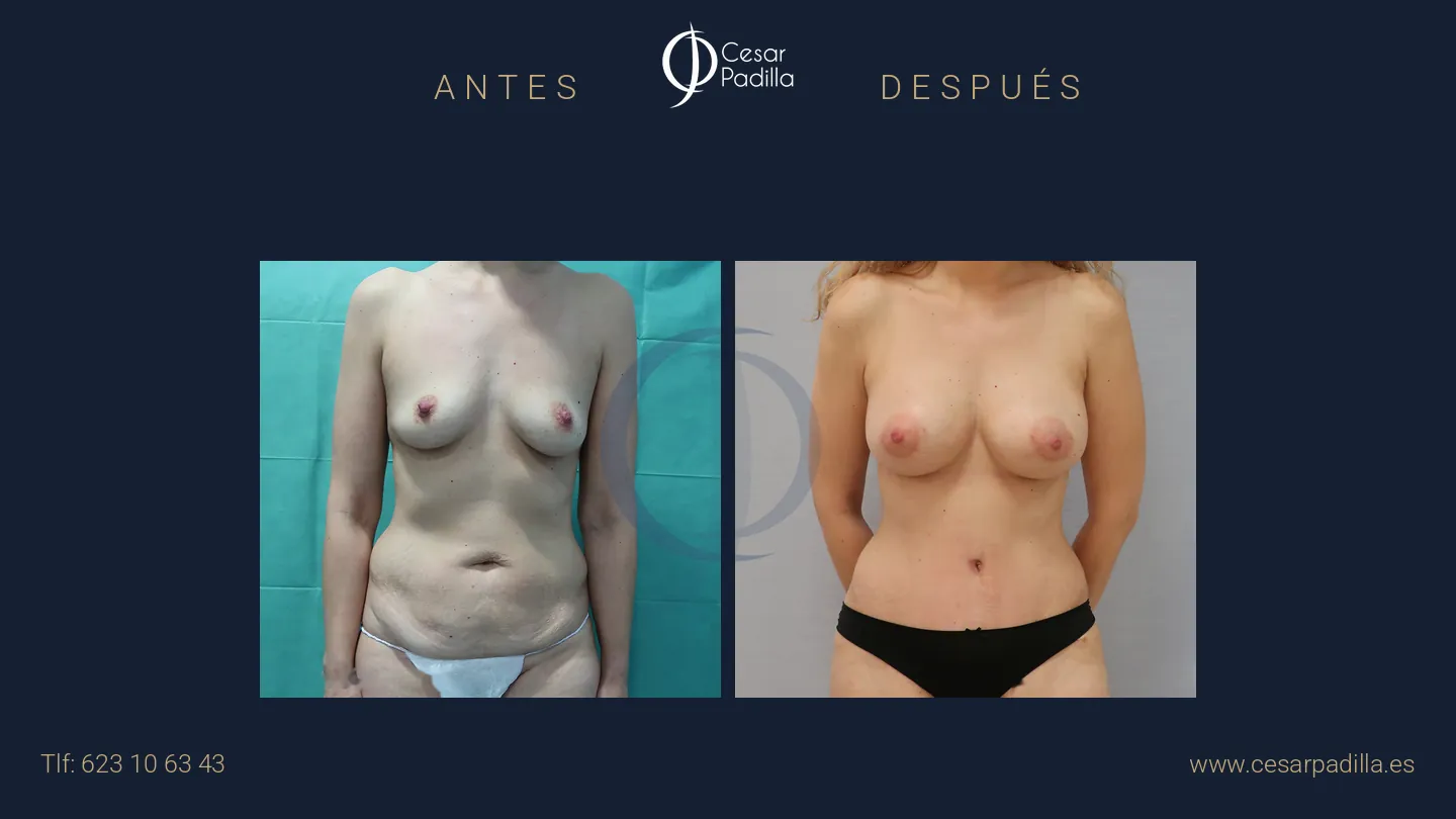 Antes y después de Mommy Makeover