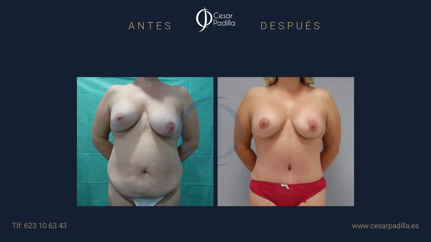 Antes y después de Mommy Makeover