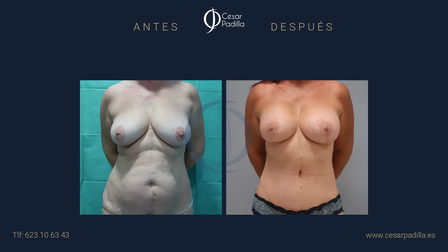 Antes y después de Mommy Makeover