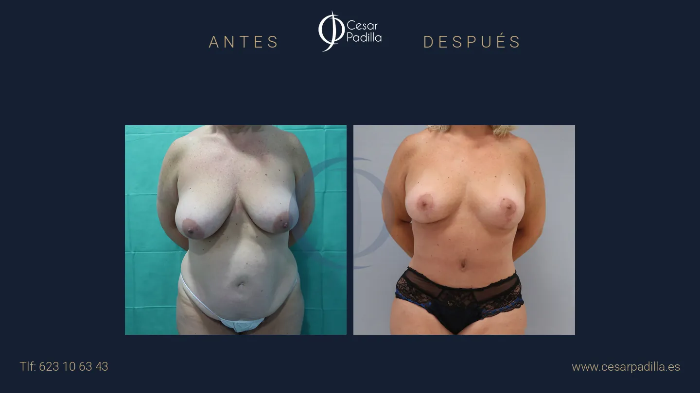 Mommy Makeover en Málaga | Dr. César Padilla