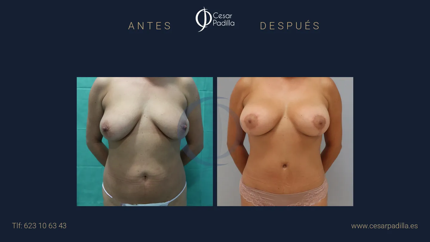 Mommy Makeover en Málaga | Dr. César Padilla