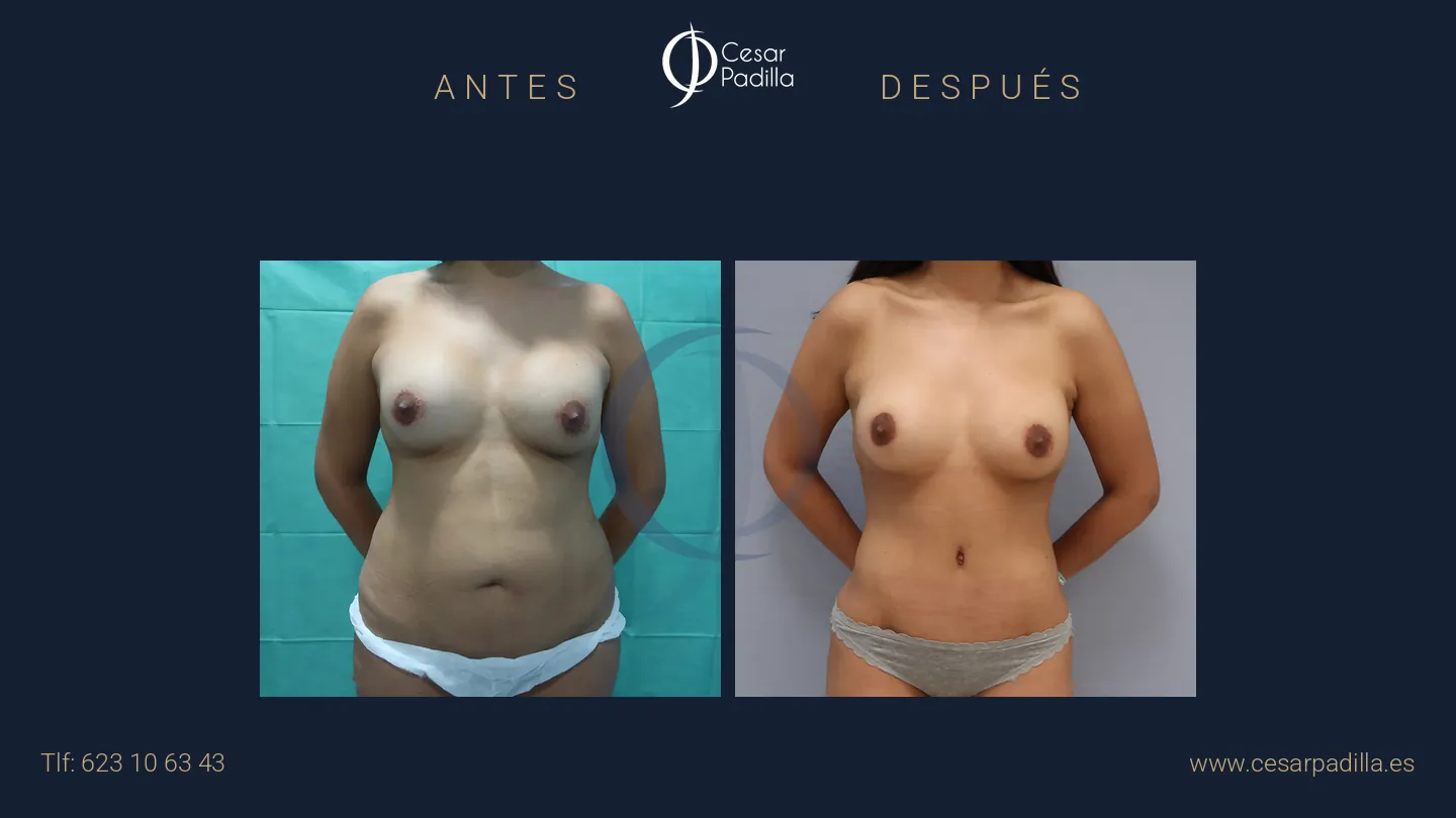 Antes y después de Mommy Makeover