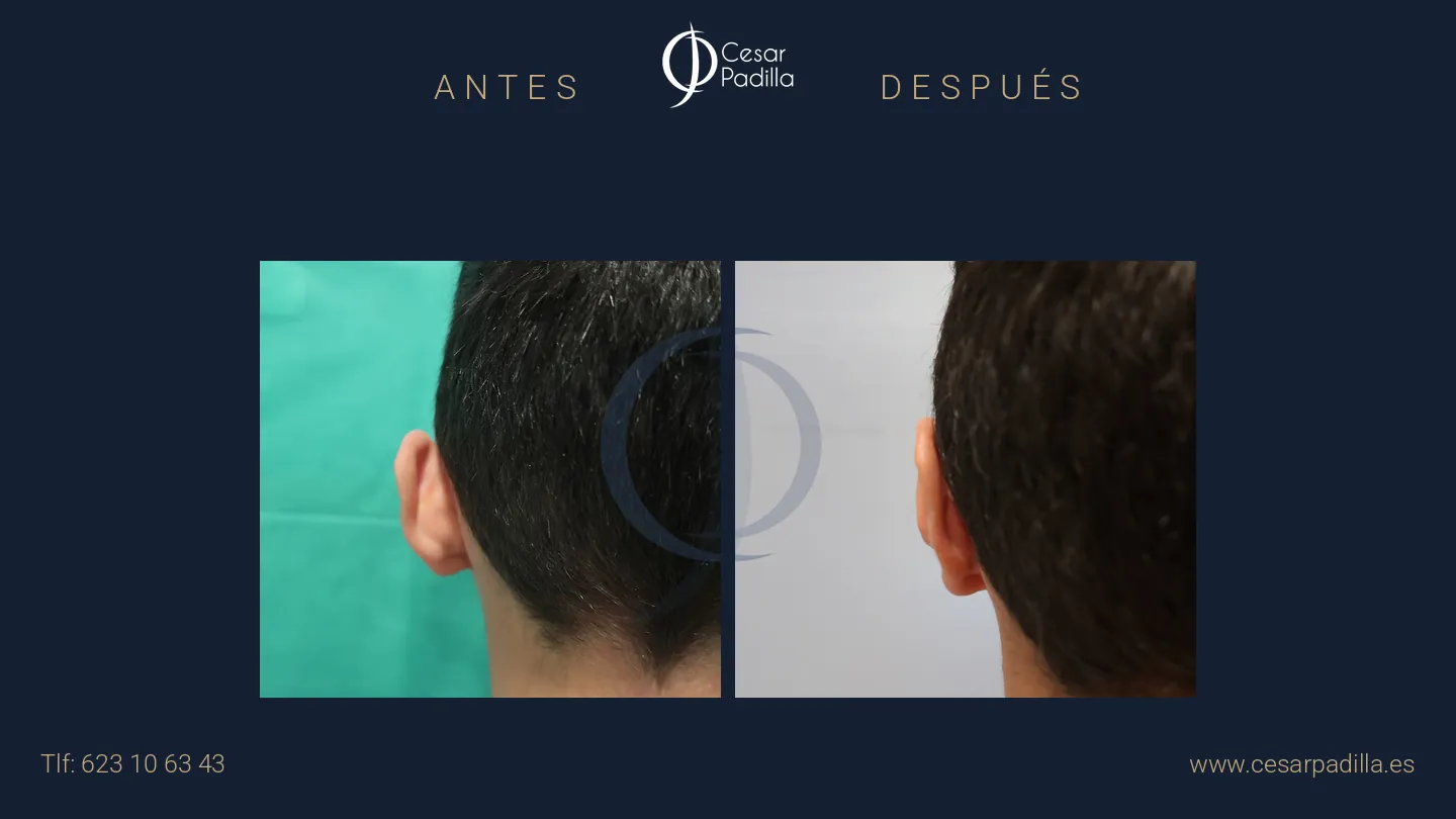 Antes y después de otoplastia, caso 1