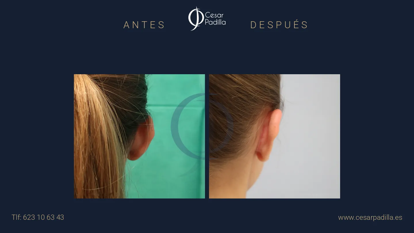 Antes y después de otoplastia, caso 2