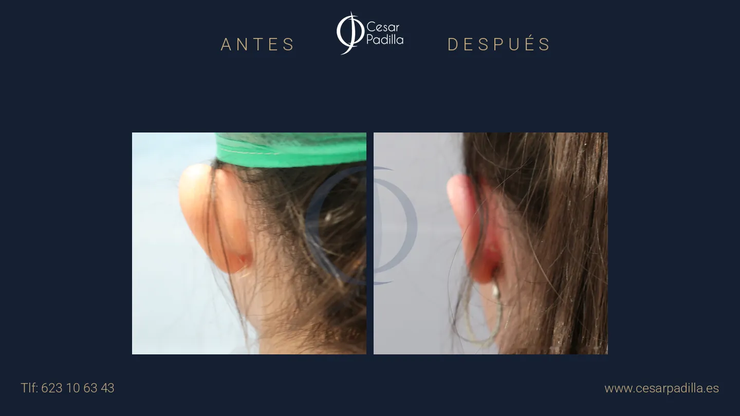 Antes y después de otoplastia, caso 3