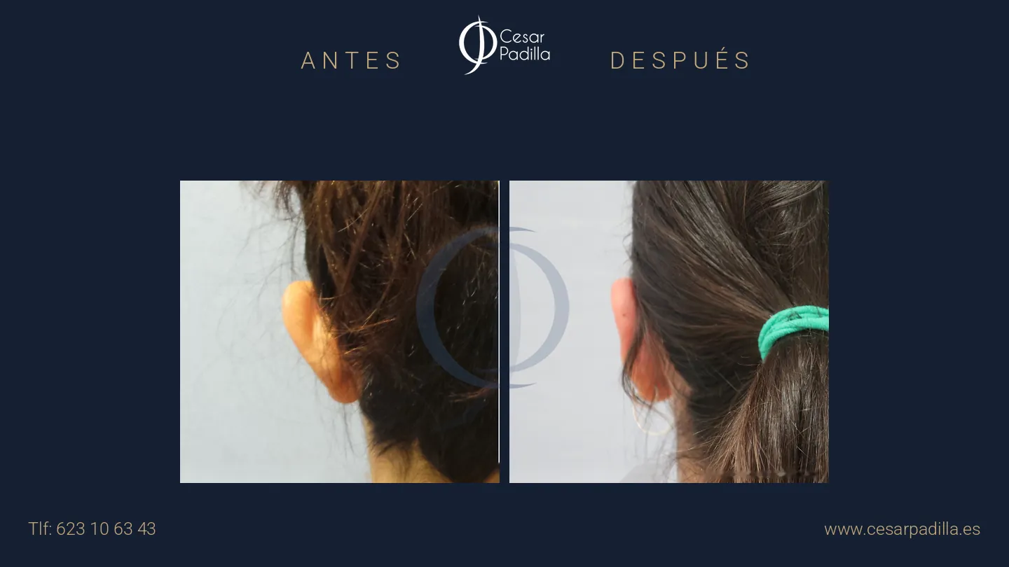 Antes y después de otoplastia, caso 4