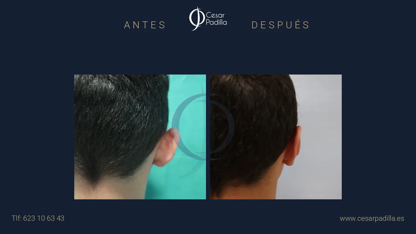 Antes y después de otoplastia, caso 5