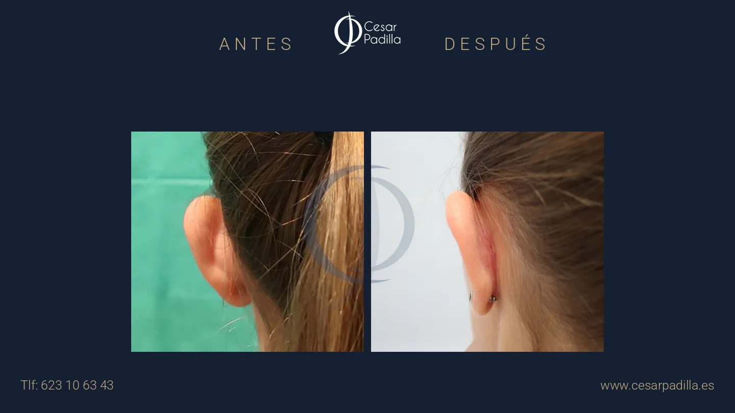 Antes y después de otoplastia, caso 6