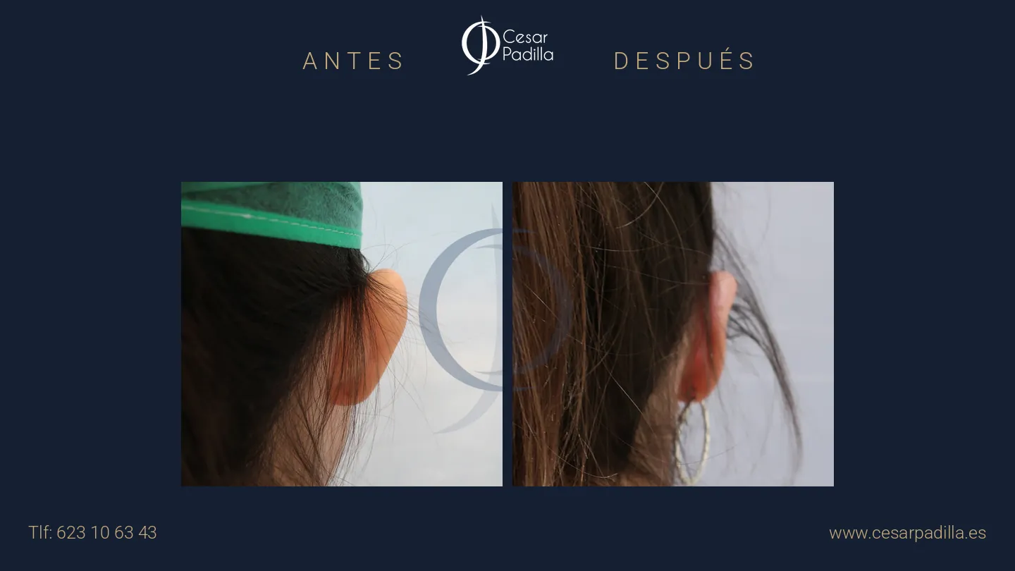 Antes y después de otoplastia, caso 7