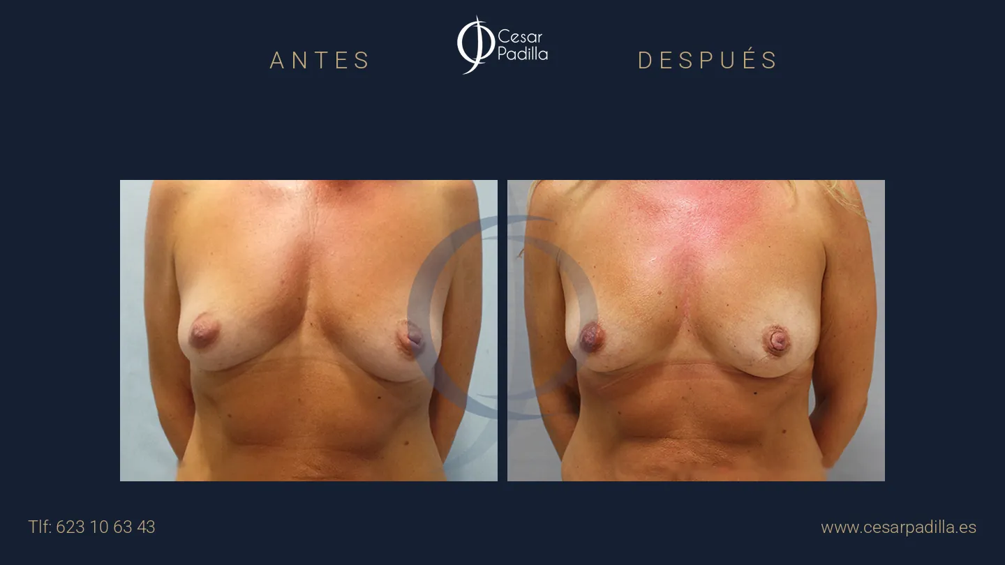 Antes y después de Pezón invertido