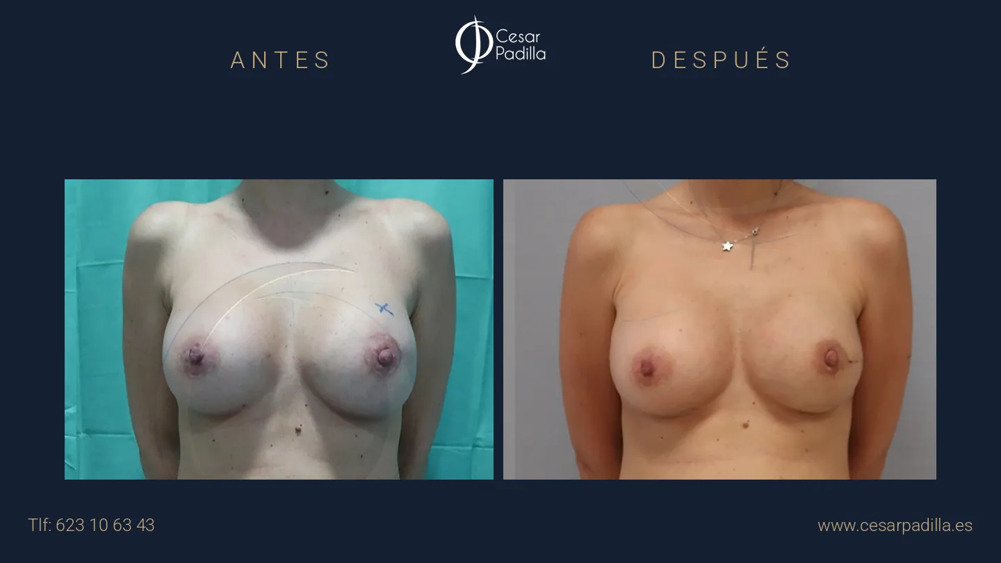 Antes y después de Reconstrucción mamaria oncológica