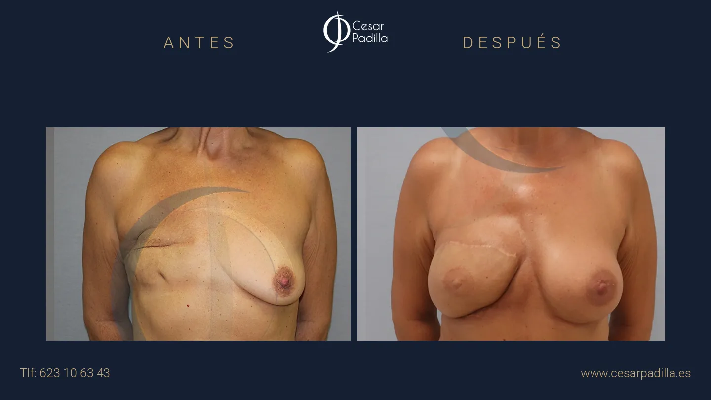 Antes y después de Reconstrucción mamaria oncológica